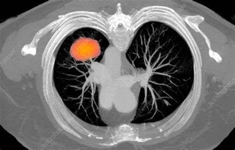 Lung Cancer Ct Scan Stock Image C Science Photo Library