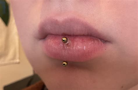 Is My Vertical Labret Getting Infected Sorry For The Gross Picture I M About 11 Days In And