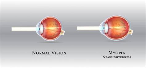 Nearsightedness Eyecare Optical Knoxville