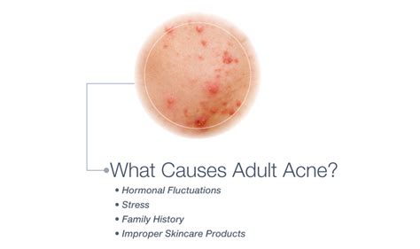 Understanding Adult Acne What Causes It And What Are The Best