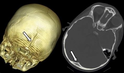 This Midline Occipital Fracture Extending Into The Fora Open I