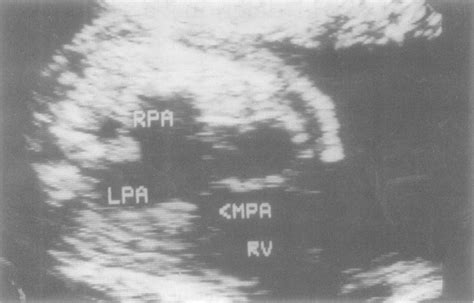 Prenatal Echocardiographic Findings In Tetralogy Of Fallot With Absent