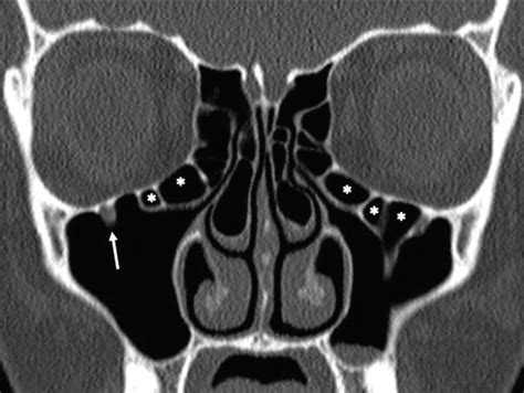 Haller cells are often cited as. Paranasal Sinus Anatomy: What the Surgeon Needs to Know ...