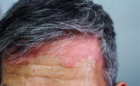 Scalp Psoriasis Vs Seborrheic Dermatitis Whats The Difference