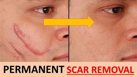 Imodstyle Remove Scar Guide 2019