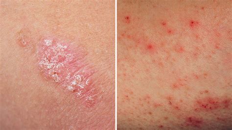 Sleepapneawhenawake Thetreatmentofeczema Skin Conditions Psoriasis