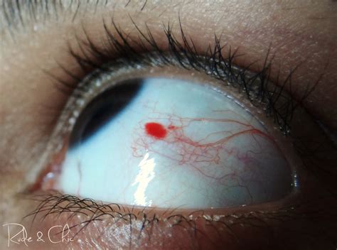 Subconjunctival Hemorrhage Broken Blood Vessels In The Eye