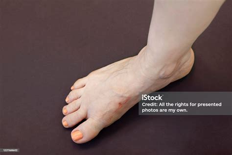 Wanita Kaki Kanan Dengan Syal Setelah Trauma Atau Operasi Akibat Sepatu
