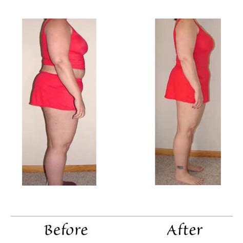 Hcg Weight Loss Before And After Telemed Newbeginnings