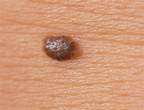 What Is Compound Nevus With Pictures