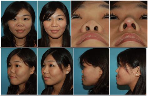 Case 4 A Case Of Saddle Nose Deformity Who Had Augmentation With