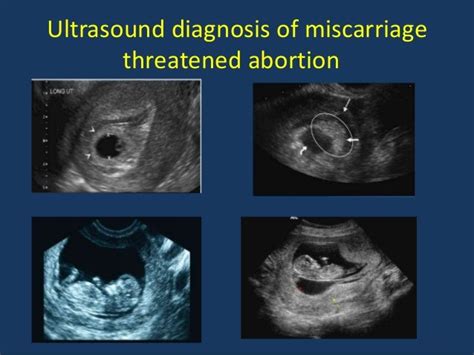 First Trimester Ultrasound