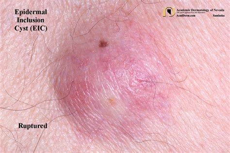 Epidermal Inclusion Cysts Eic Epidermoid Cysts Academic