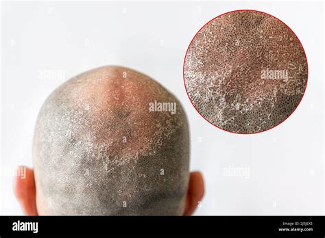 Mans Bald Flaky Head With Dandruff Close Up Back View White