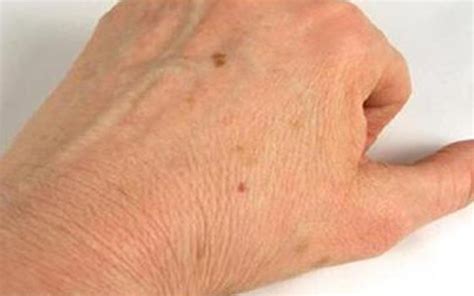 Indications Of Brown Spots On The Skin Teller Report
