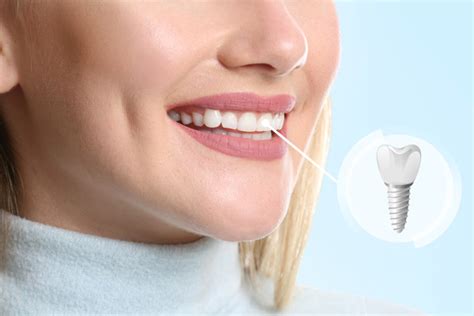 Full Mouth Reconstruction Dental Implants Charleston Wv