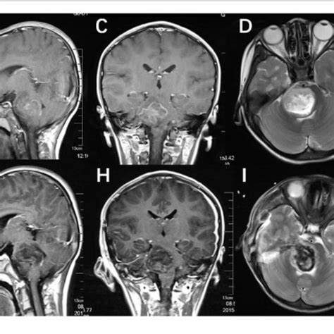 A D Preoperative Mri Scan Axial Coronal Sagittal T1 Weighted