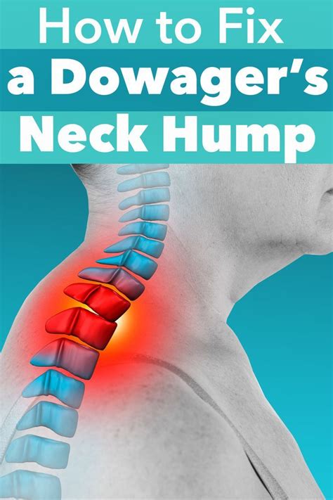 How To Fix A Dowager S Neck Hump Posture Correction Exercises Better Posture Exercises Bad