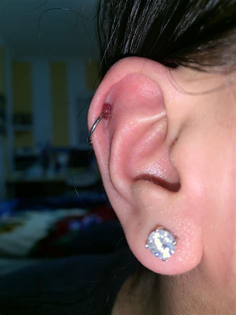 7 Month Cartilage Piercing Bump Question Rpiercing