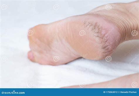 Dry Cracked Skin On The Heels Of A Person S Legs Close Up The Concept