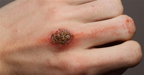 How To Get Rid Of Scabs And Learn How To Make A Scab Heal Faster