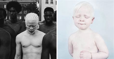 Photographers Capture The Unique Beauty Of Albino People