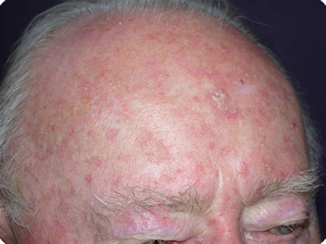 Actinic Keratosis Treatment Options Tell Us What Is Actinic Keratosis