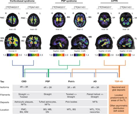 Tau Pet Imaging In Neurodegenerative Tauopathies—still A Challenge