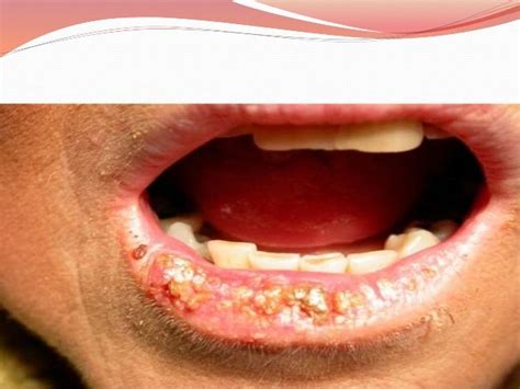 Diseases Of The Lips And Tongue