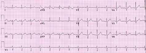 Study Medical Photos Left Anterior Fascicular Block Ecg