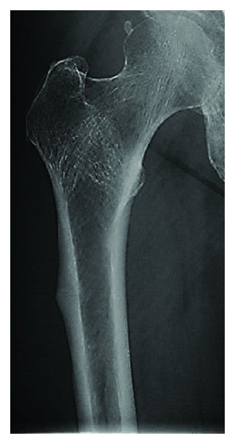 Radiographs Of The Right Femur Before And After The Atypical Fracture