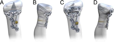 Complex Radial Head And Neck Fractures Treated With Modern Locking