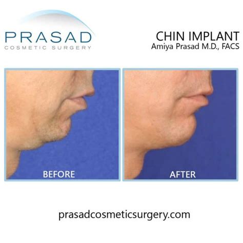 Chin Augmentation Chin Implant By Dr Amiya Prasad New York