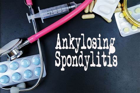 treatments for ankylosing spondylitis facty health