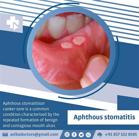 Aphthous Stomatitis Homeopathy Homeopathic Medicine Homeopathic
