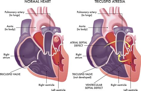 Tricuspid Atresia A Type Of Congenital Heart Disease The Pulse
