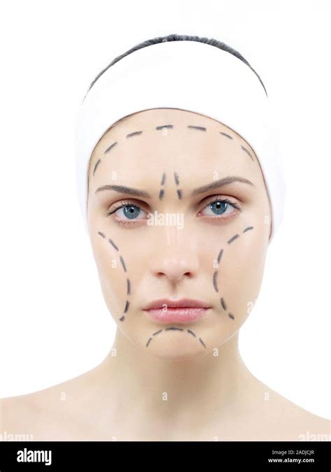 Facelift Surgery Markings Guide Lines For Surgical Incisions On A