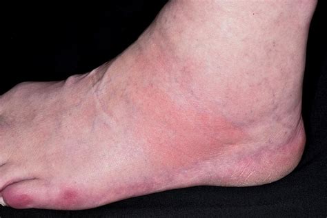 Gout Swollen Foot And Ankle GoutInfoClub Com