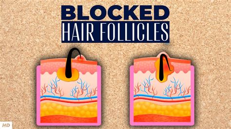 Aggregate Clogged Hair Follicle Best In Eteachers