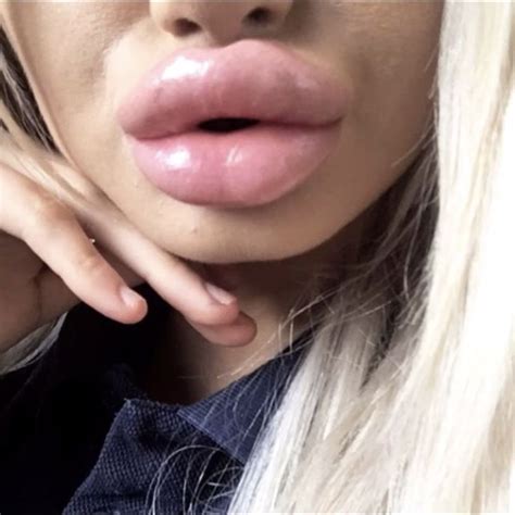 Pin By Anders Rudbeck On Lips And Fillers Lip Plumper Fake Lips