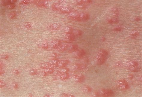 Red Papules On The Skin Due To Scabies Stock Image M260 0127