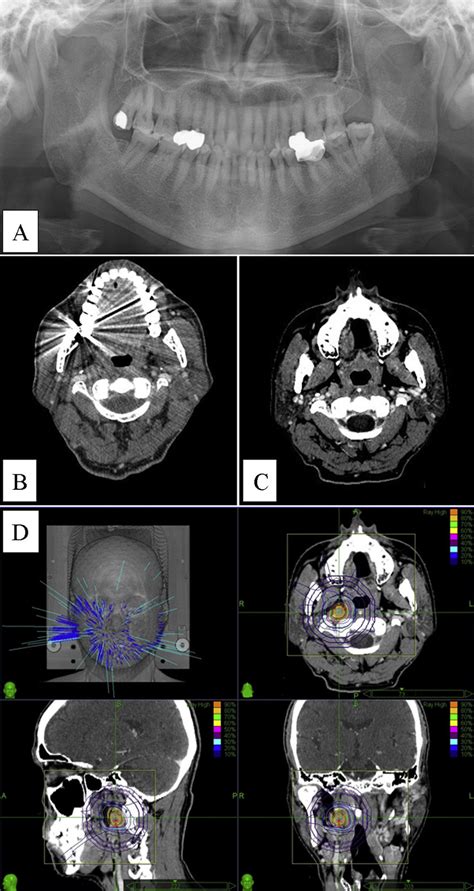 Patient With Secondary Retropharyngeal Lymph Node Metastasis From