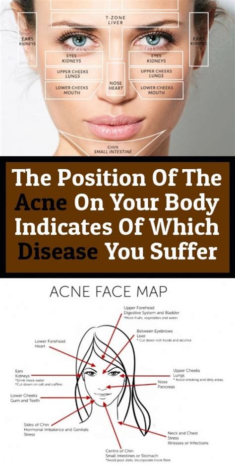 The Position Of Acne On Your Body Indicates The Diseases You Suffer
