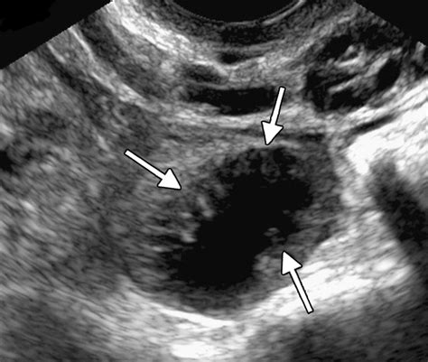 Adnexal Masses US Characterization And Reporting Radiology