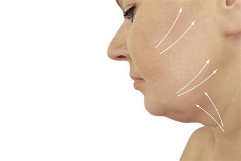 Chin Lift Natural And Pain Free Contouring And Double Chin Removal