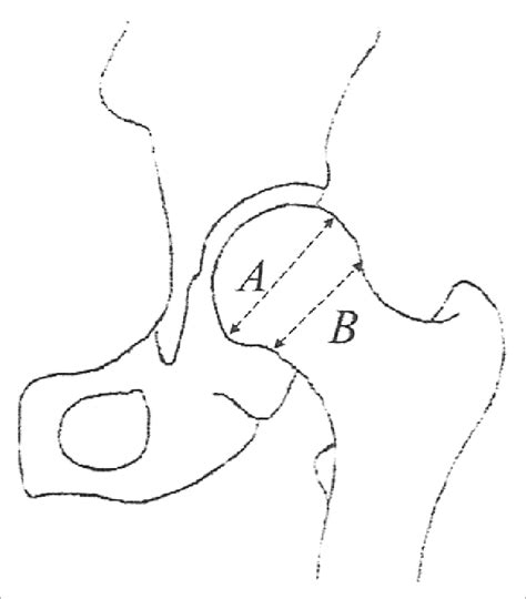 Femoral Measurement Femoral Head Neck Ratio A B Calculated By