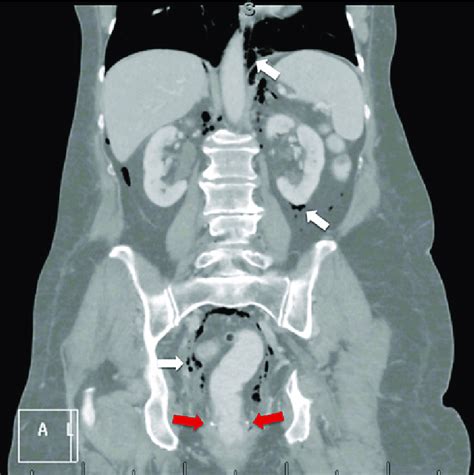 Ct Scan Showing Pneumoretroperitoneum At The Level Of The Mesorectum