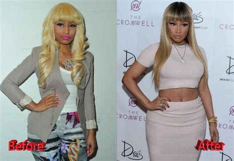 Nicki Minaj Plastic Surgery Procedures