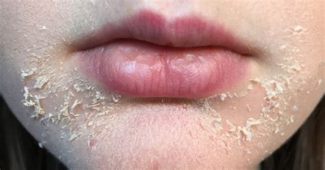 Dry Scaly Skin Around Lips Lipstutorial Org