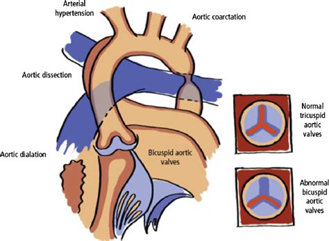 Illustration Of The Occurrence Of Bicuspid Aortic Valves Aortic